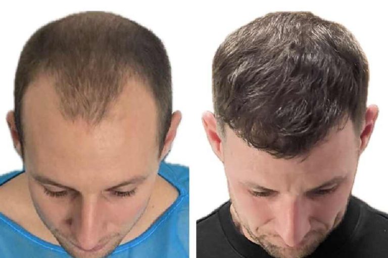 La greffe de cheveux Choi, pour quels résultats ? La greffe de cheveux Choi, pour quels résultats ?